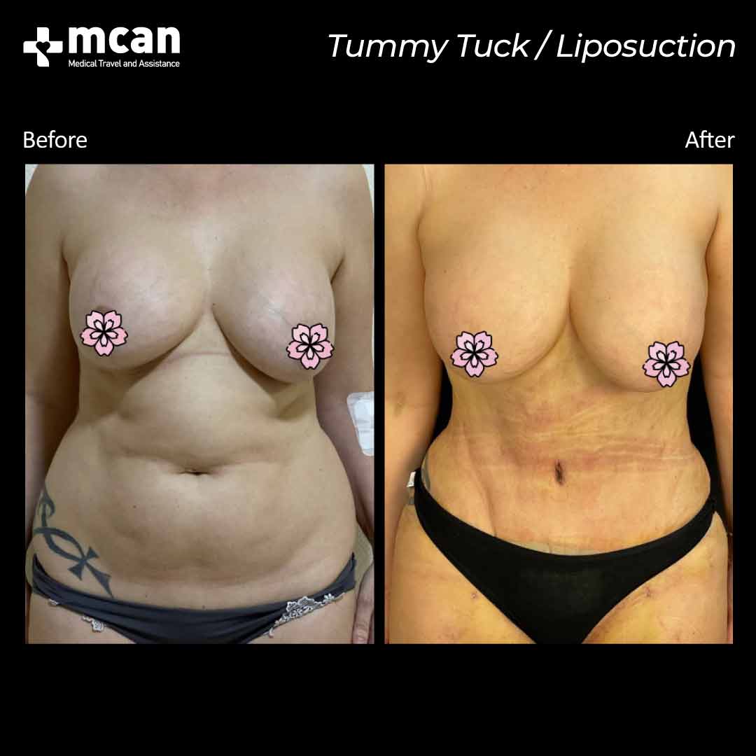 tummy tuck liposuction turkey before after 200501