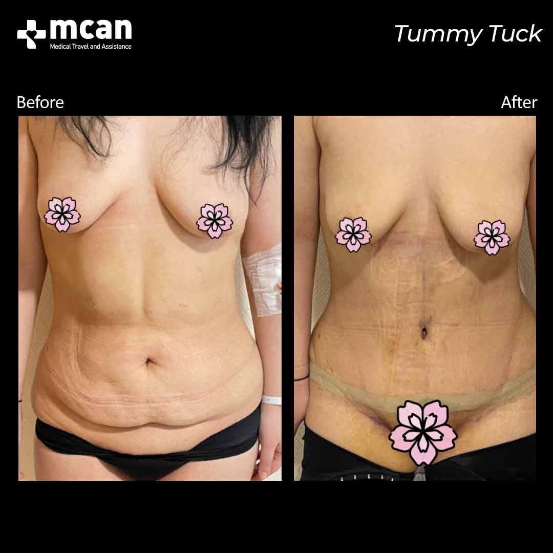 tummy tuck turkey before after 200501