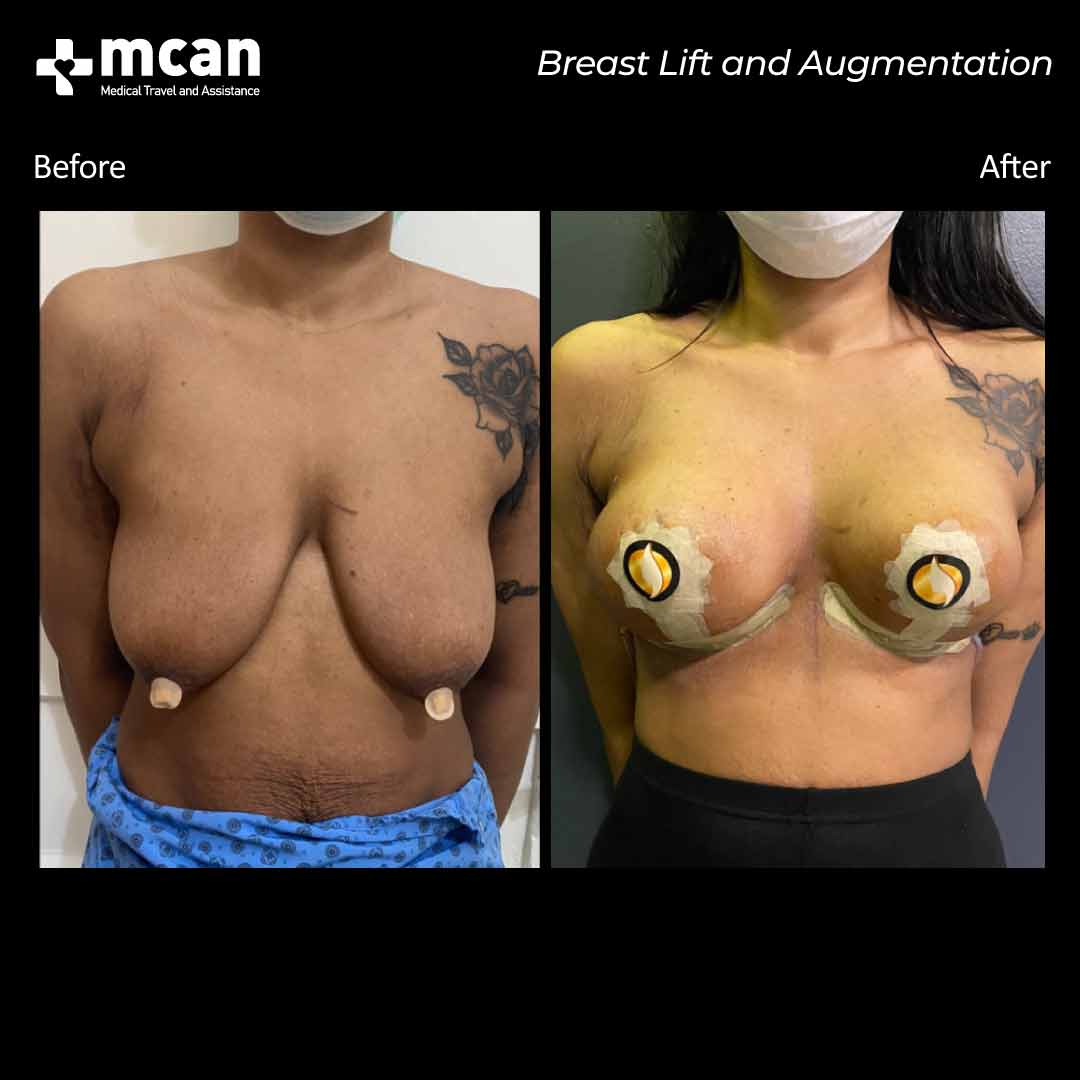 breast lift and augmentation in turkey before after 2106202101