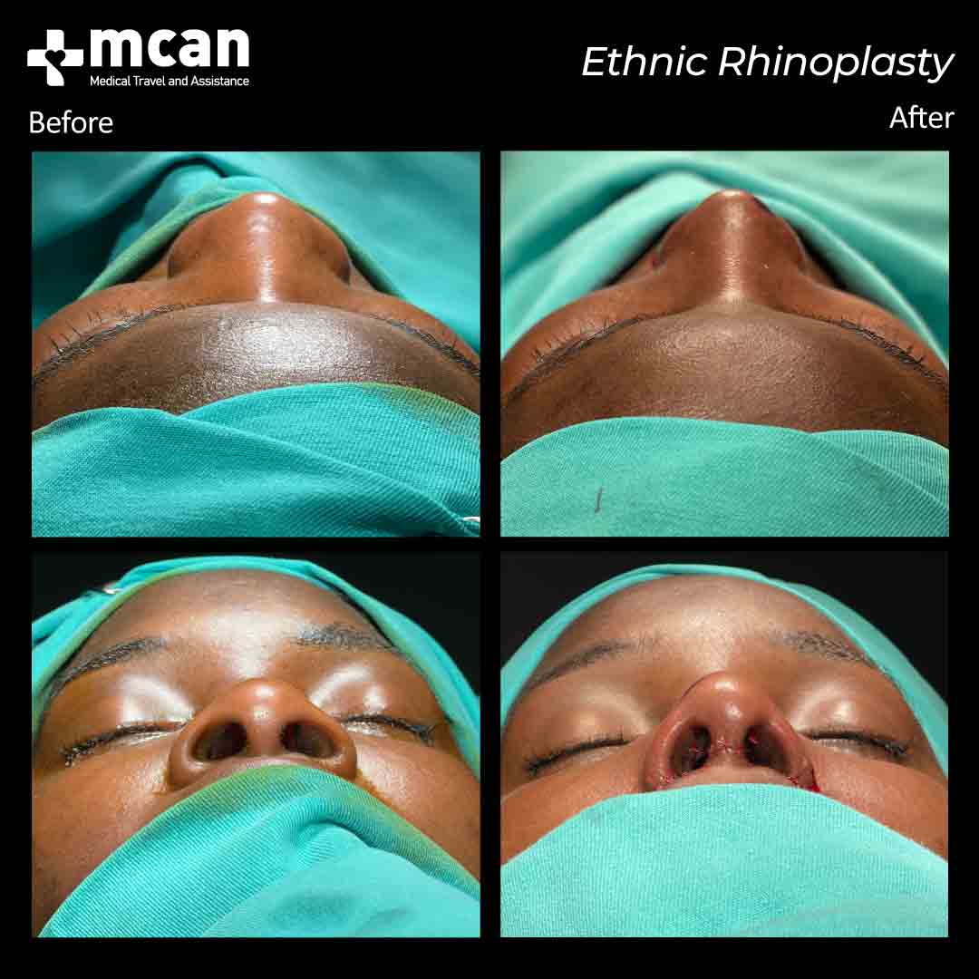 ethnic rhinoplasty in turkey