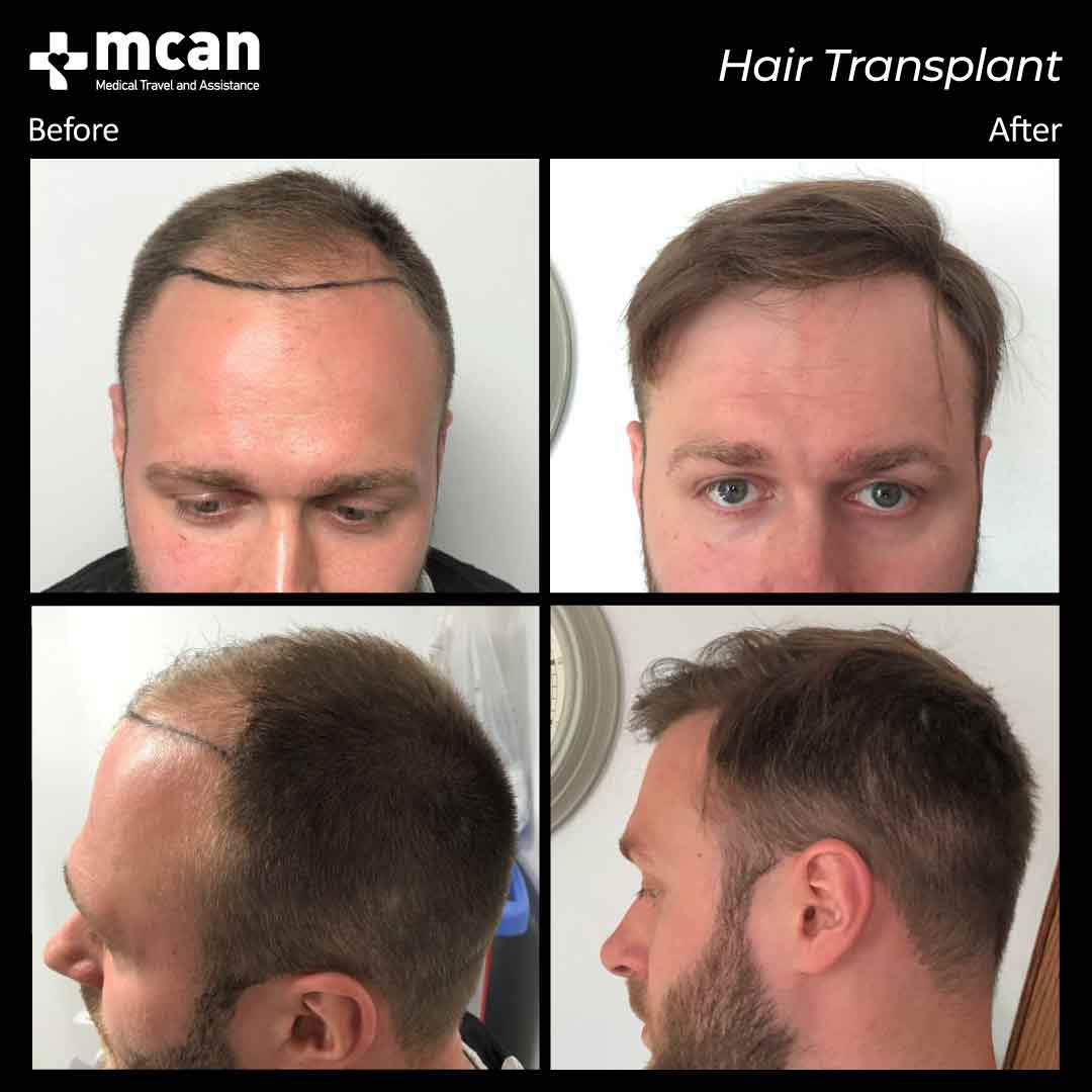 hair transplant in turkey before after 2106202101