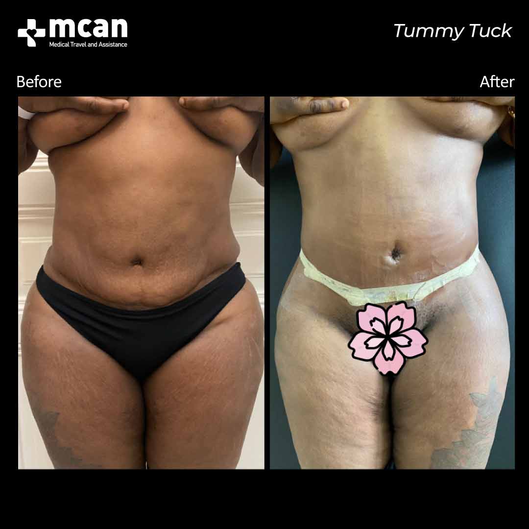 tummy tuck in turkey before after 2106202101