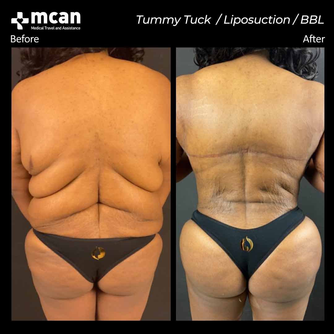 tummy tuck liposuction bbl in turkey before after 2106202101
