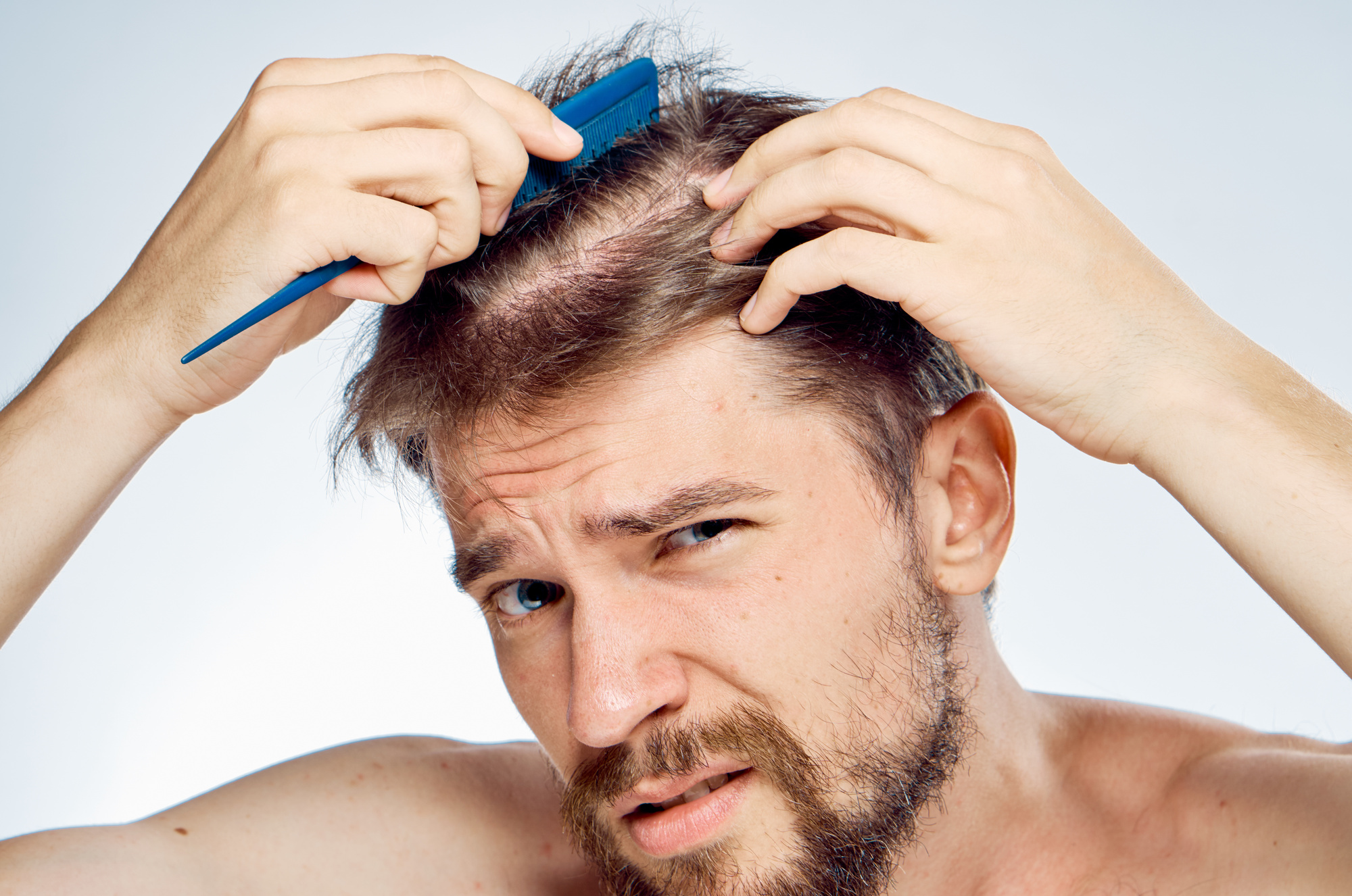 Los Efectos Secundarios Del Minoxidil MCAN Health Turqu a alopecia-and-hair-loss-causes-symptoms-and-treatment