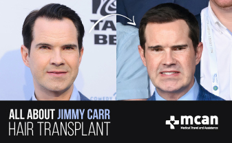 All About Jimmy Carr Hair Transplant Turkey