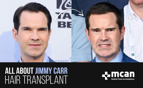 all about jimmy carr hair transplant