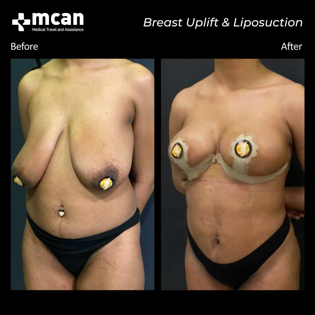 breast uplift liposuction turkey before after 12072101