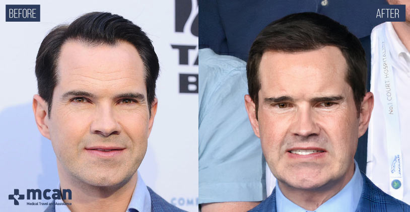 Everything About Jimmy Carr Hair Transplant