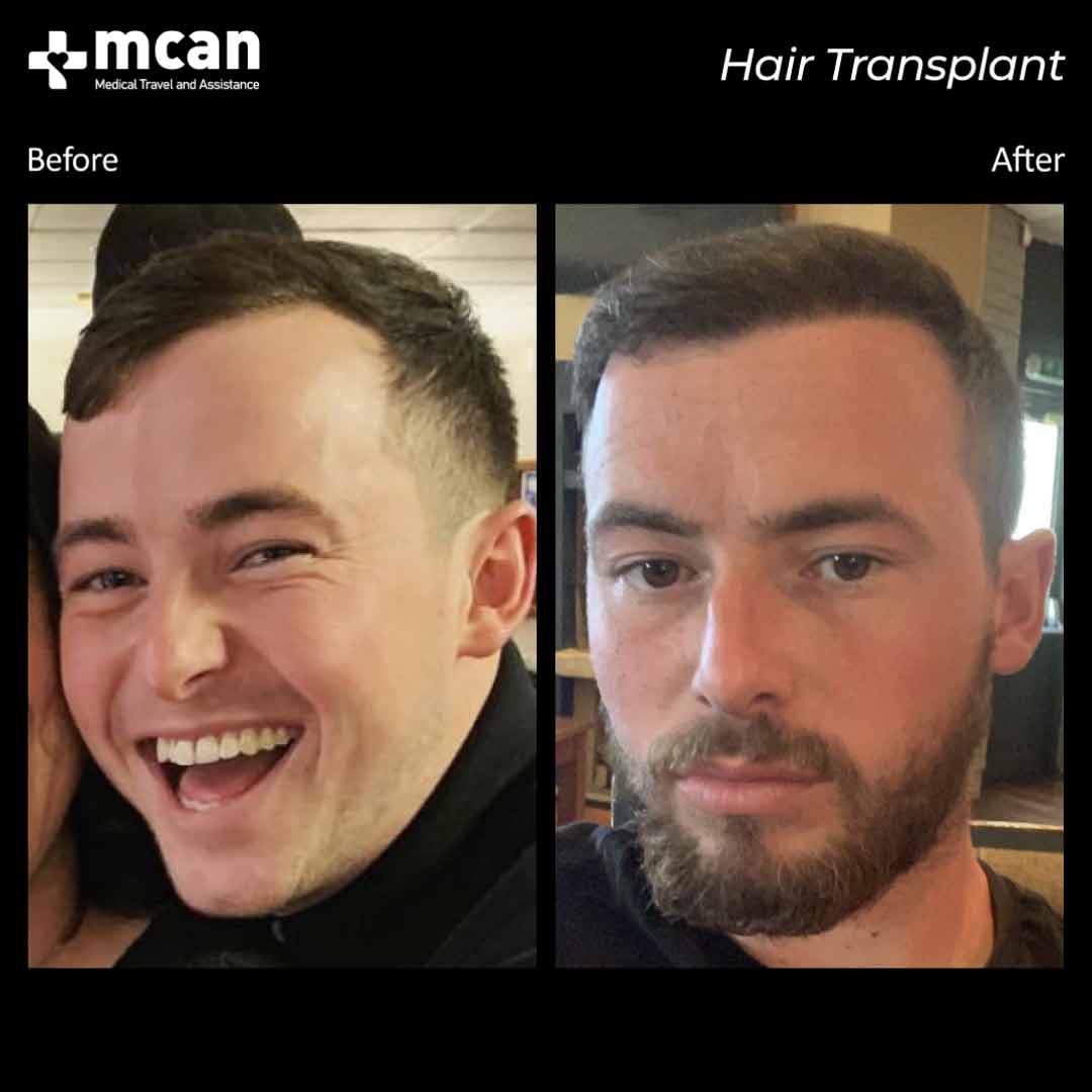 Hair Transplant Turkey Before After