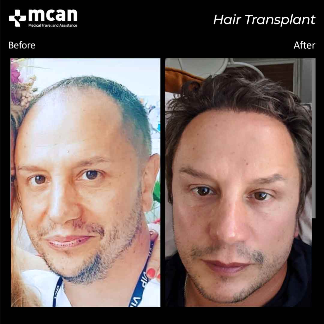 Hair Transplant Turkey Before After