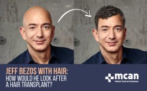 Jeff Bezos with hair: how he would look after a hair transplant?