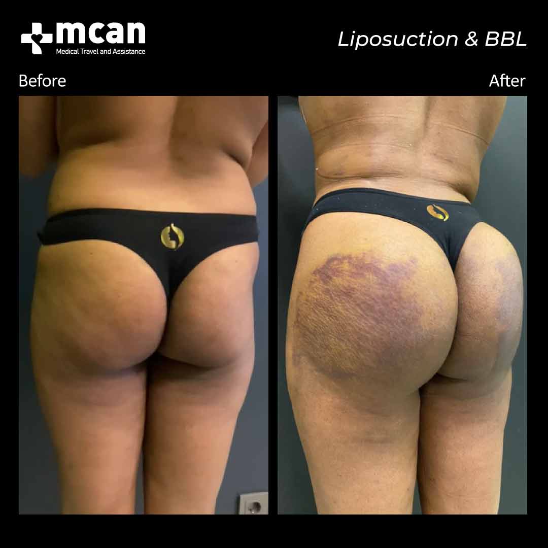 liposuction bbl turkey before after 12072101