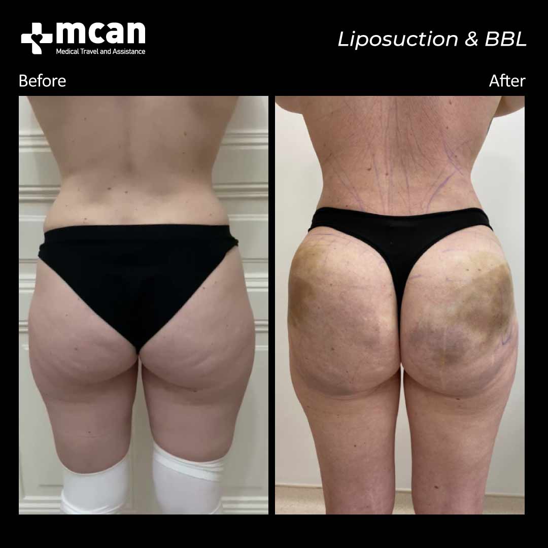 liposuction bbl turkey before after 12072102