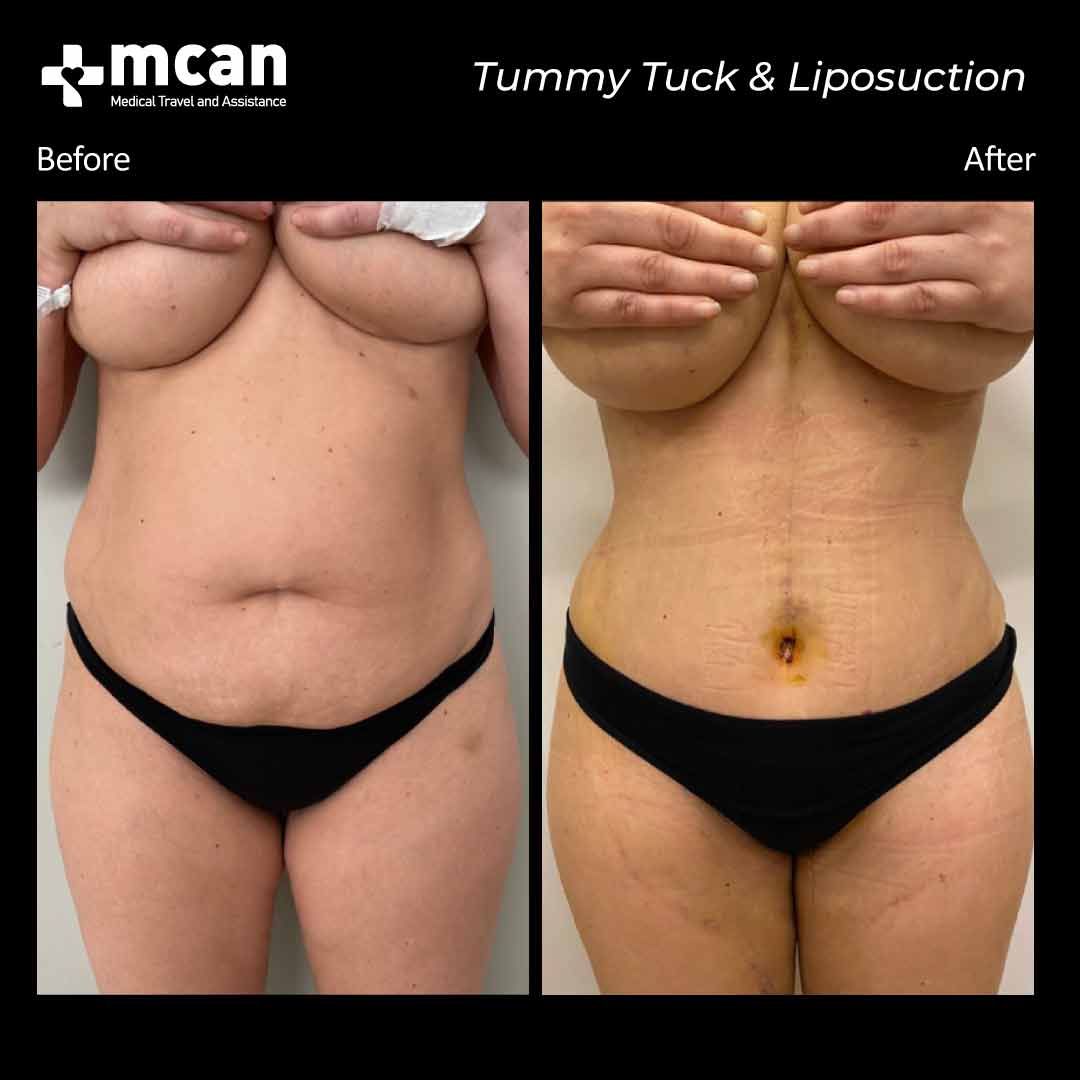 liposuction tummy tuck turkey before after 12072101