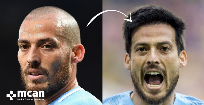 Celebrity Hair Transplant Stories and Before and After Photos 10 BLOG DOSYASI ara gorsel Famous hair transplant before and after david silvia