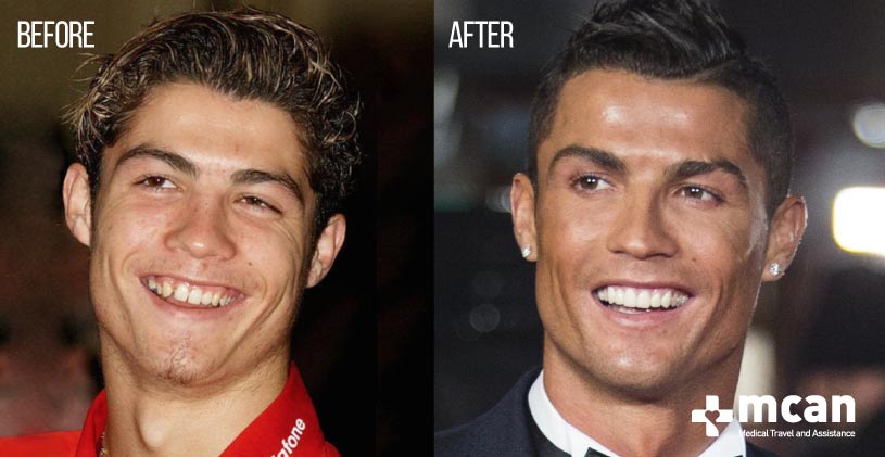 Celebrity Plastic Surgery: Transformations That Inspire 2 Cristiano Ronaldo blog before after min Before and After Cristiano Rolando Surgeries | MCAN Health Turkey