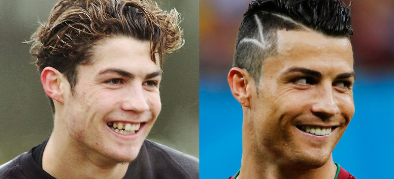 Cristiano Ronaldo veneer and teeth before and afters