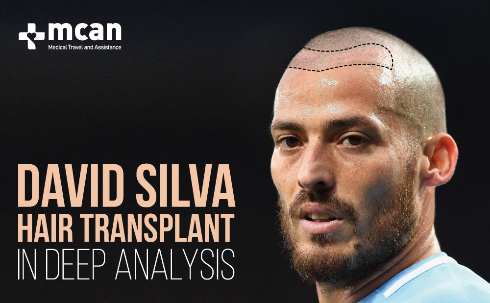 David Silva Hair Transplant, why did he shave his head?