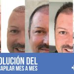 Evolución del injerto capilar mes a mes | MCAN Health Turquía