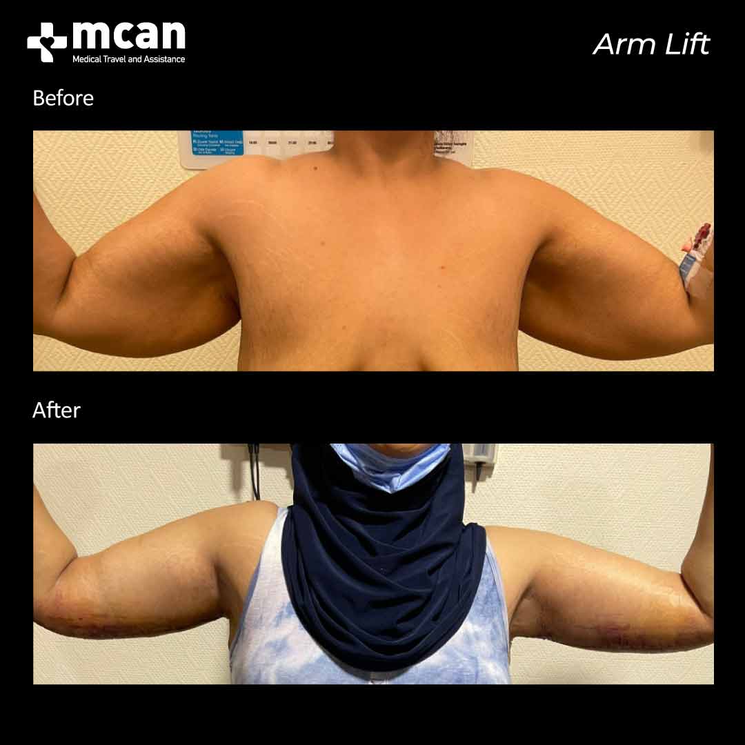 arm lift in turkey before after 0607202101