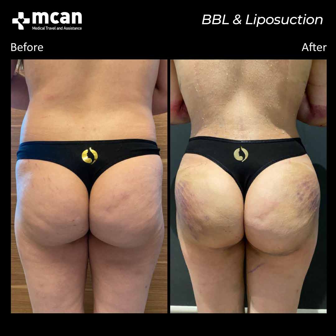 bbl liposuction in turkey before after 0607202101