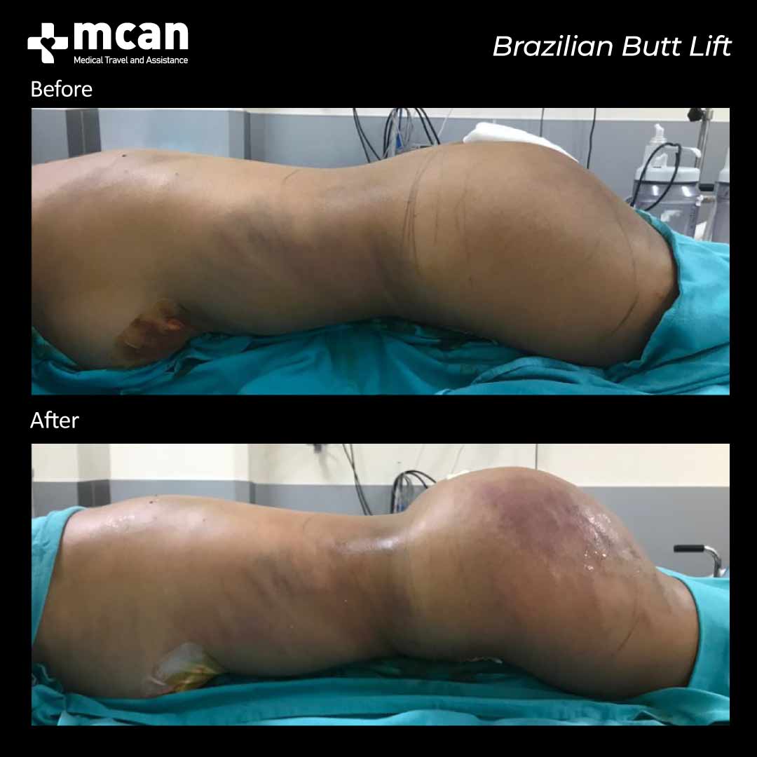 brazilian butt lift in turkey before after 0607202101