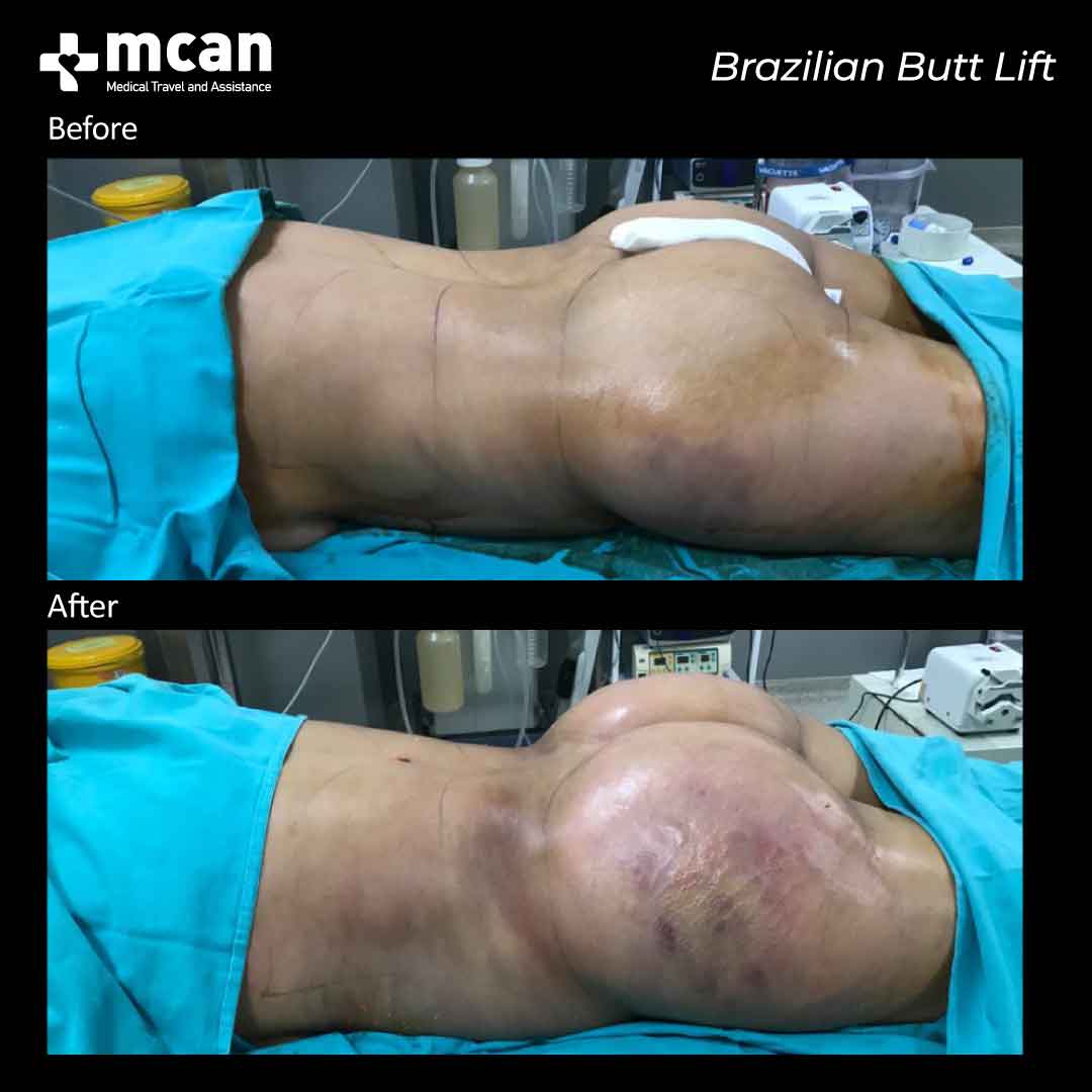 brazilian butt lift in turkey before after 0607202102