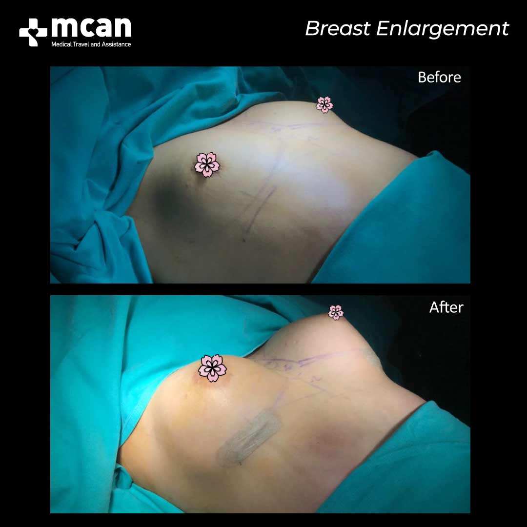 breast enlargement in turkey before after 0607202103