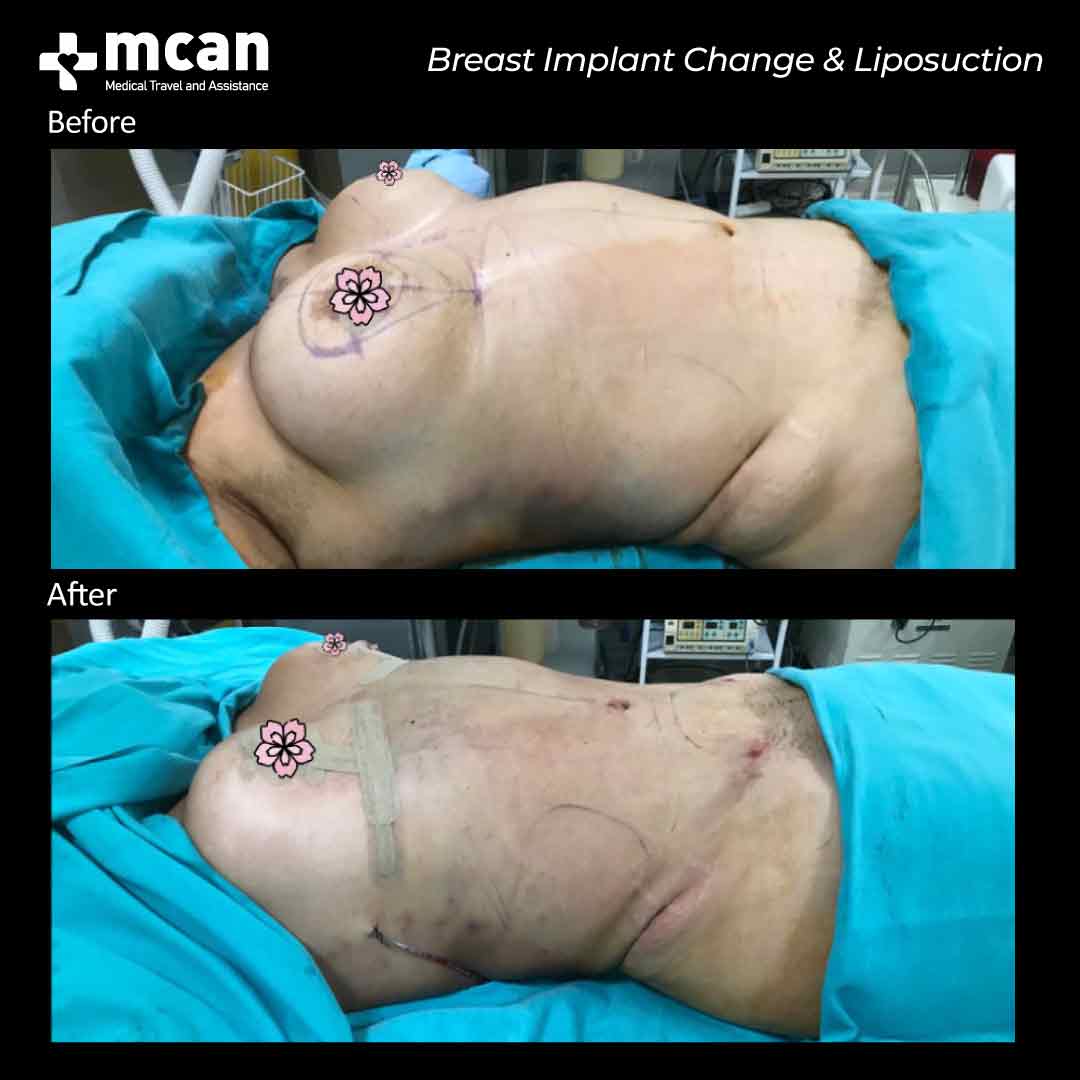 breast implant change liposuction in turkey before after 0607202101