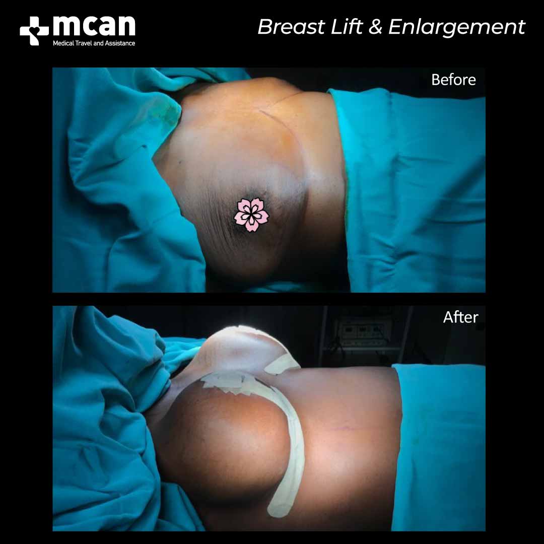 breast lift breast enlargement in turkey before after 0607202101