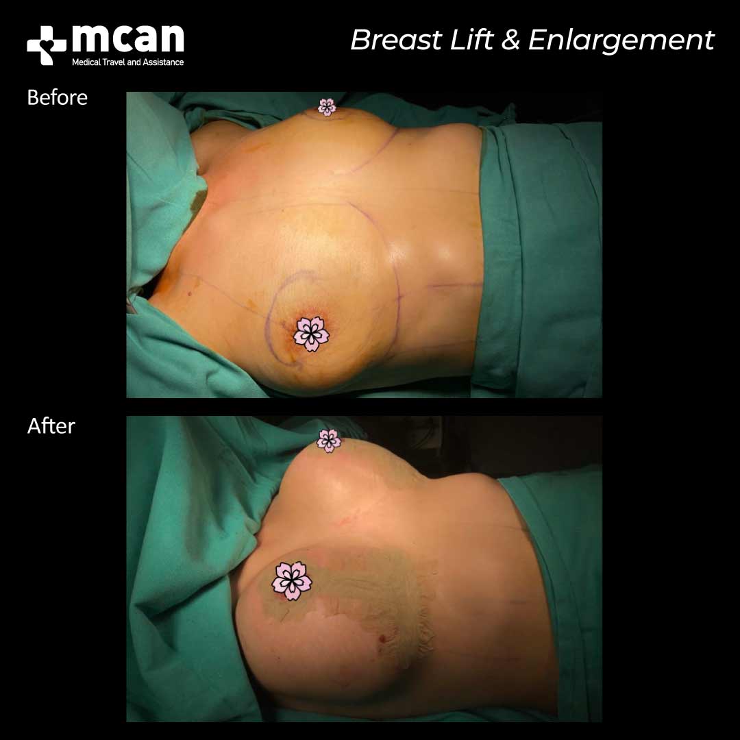 breast lift breast enlargement in turkey before after 0607202103