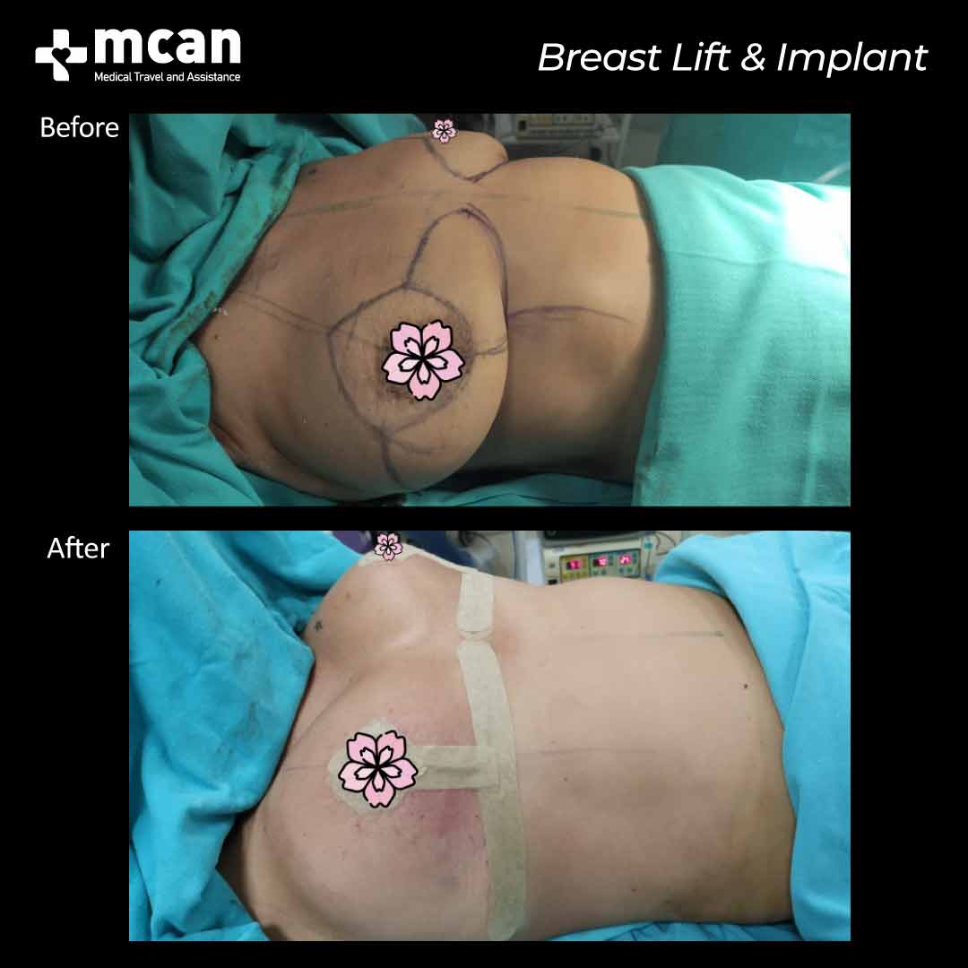 breast lift breast implant in turkey before after 1008202101