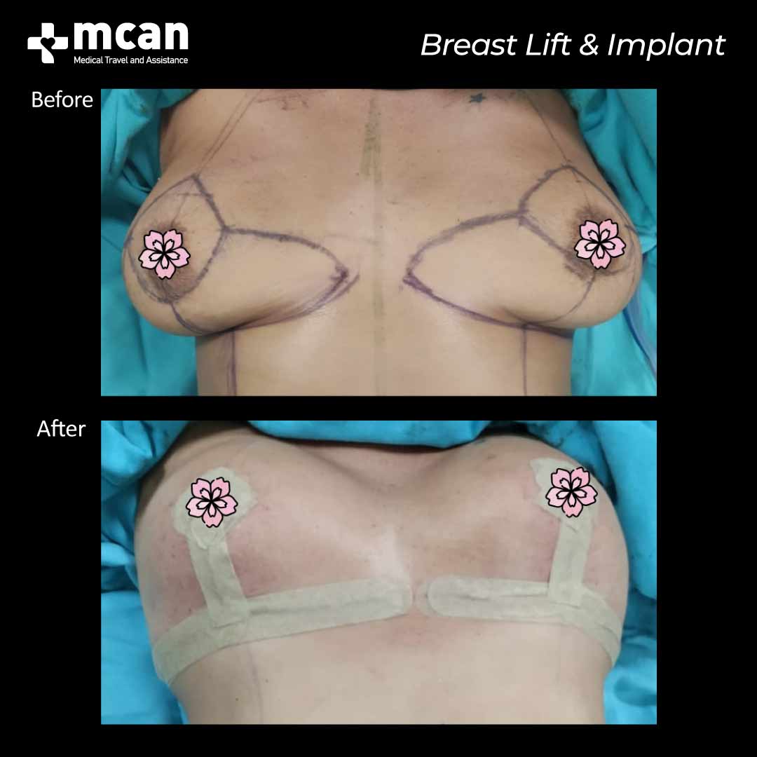 breast lift implant in turkey before after 1008202101