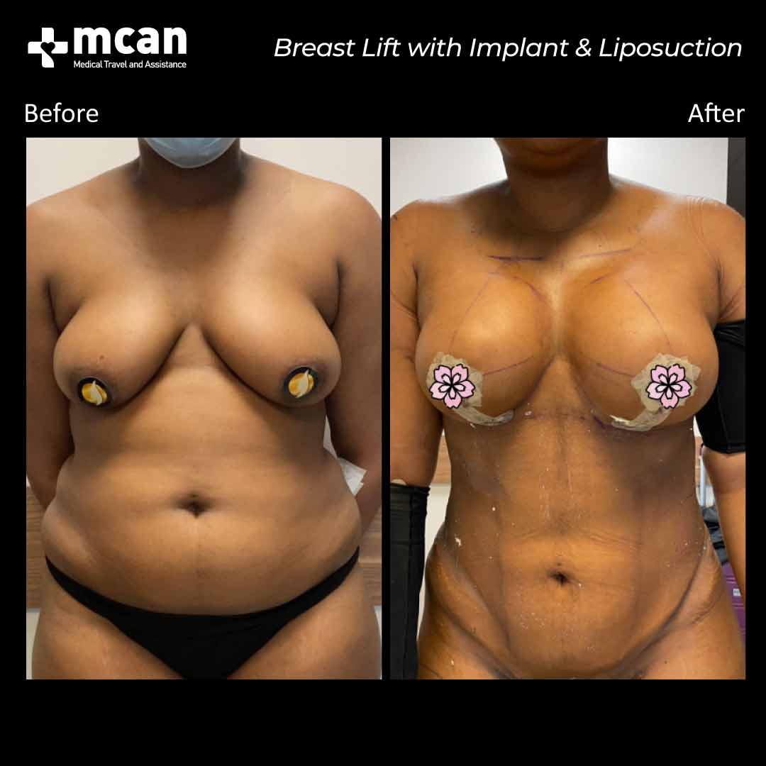 breast lift with implant in turkey liposuction before after 1008202101