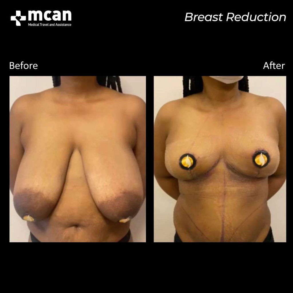 breast reduction in turkey before after 0607202101