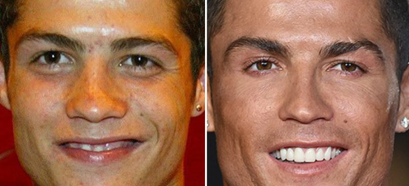 Cristiano Ronaldo nose job before and after