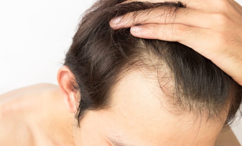 5 Reasons Why You Should NOT Have a Hair Transplant 3 hairloss at 18 scaled e1656422001392 hair transplant