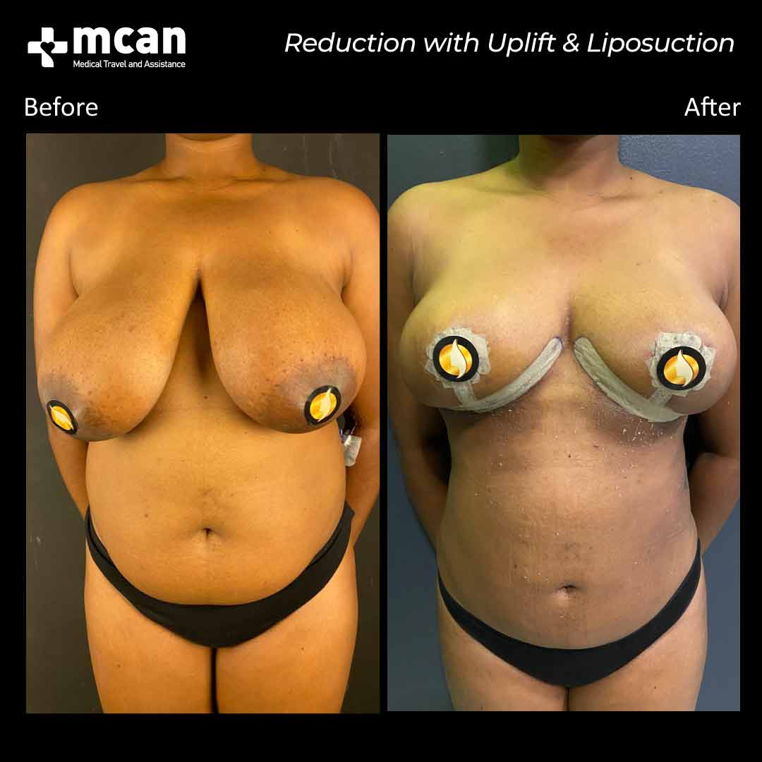 liposuction breast reduction with breast uplift in turkey before after 1008202101