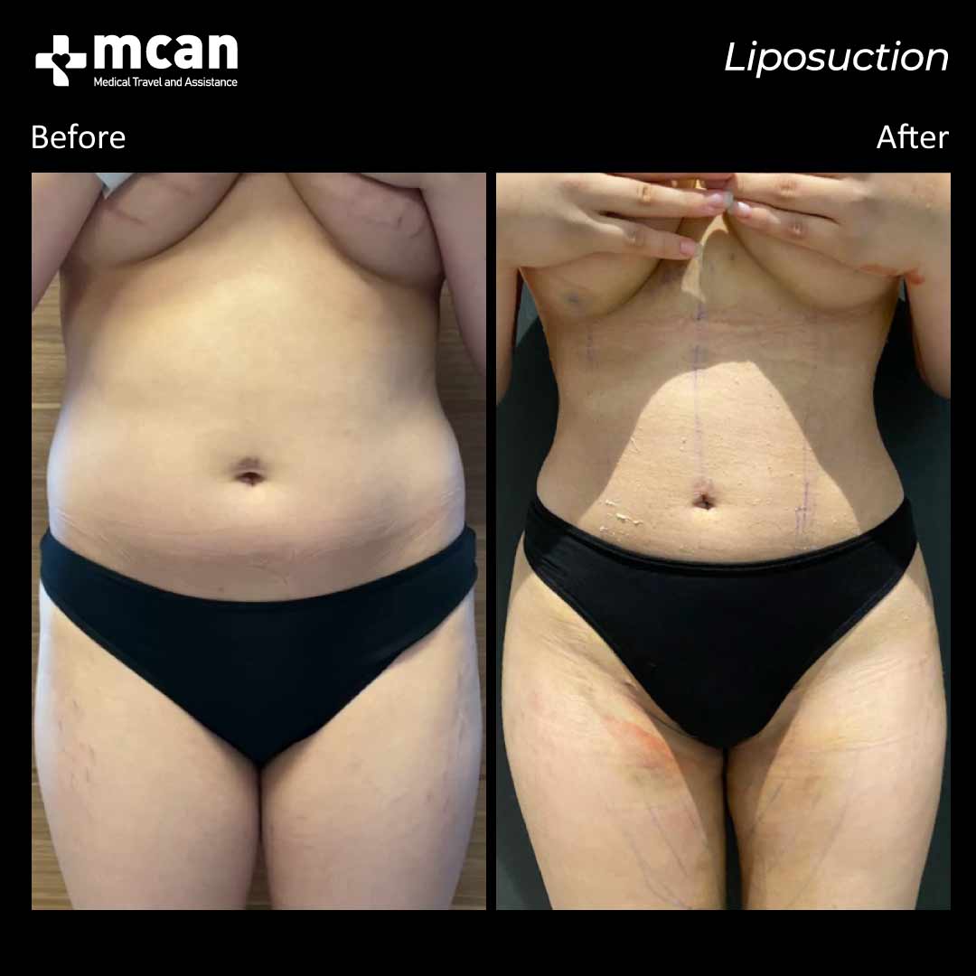 liposuction in turkey before after 0607202101