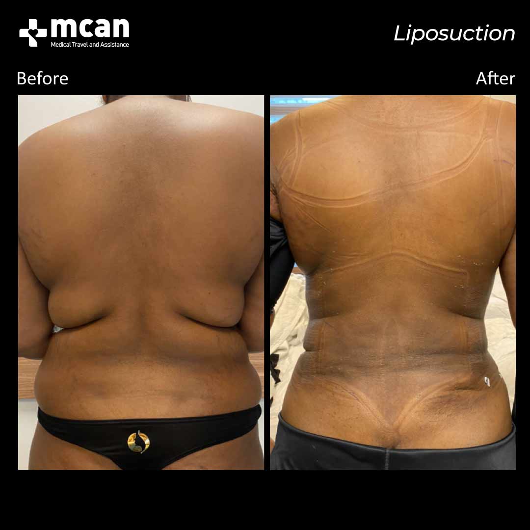 liposuction in turkey before after 1008202101