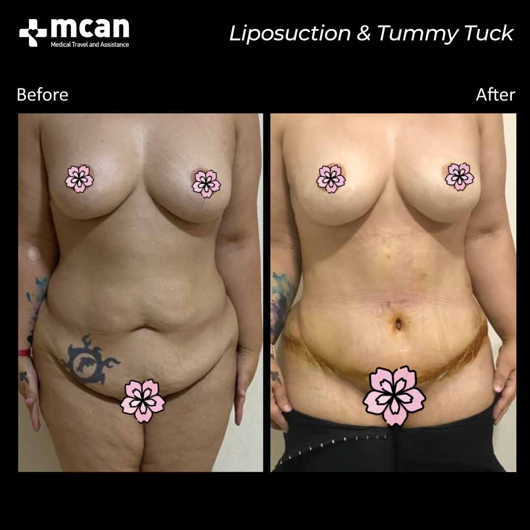 liposuction tummy tuck in turkey before after 1008202101