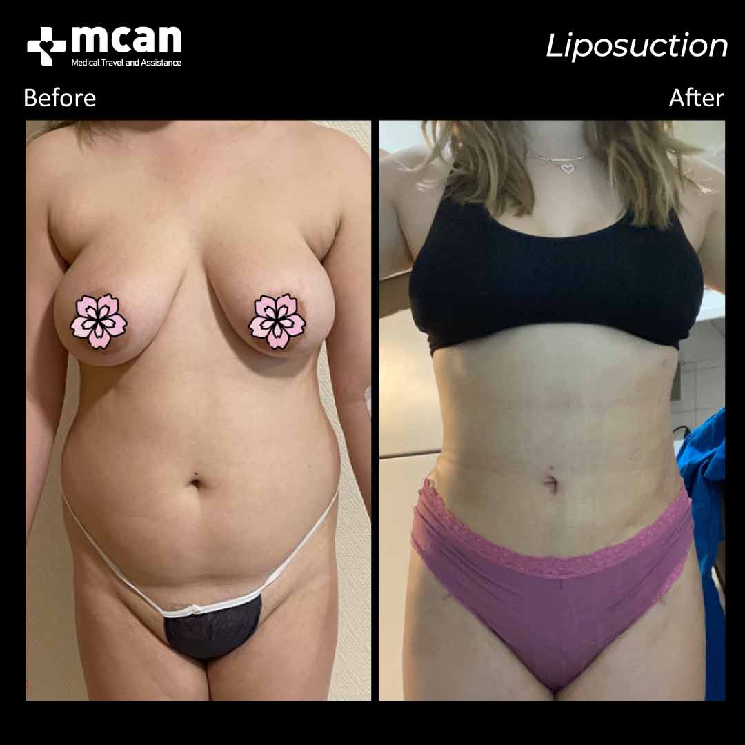 liposuction turkey before after 1008202101