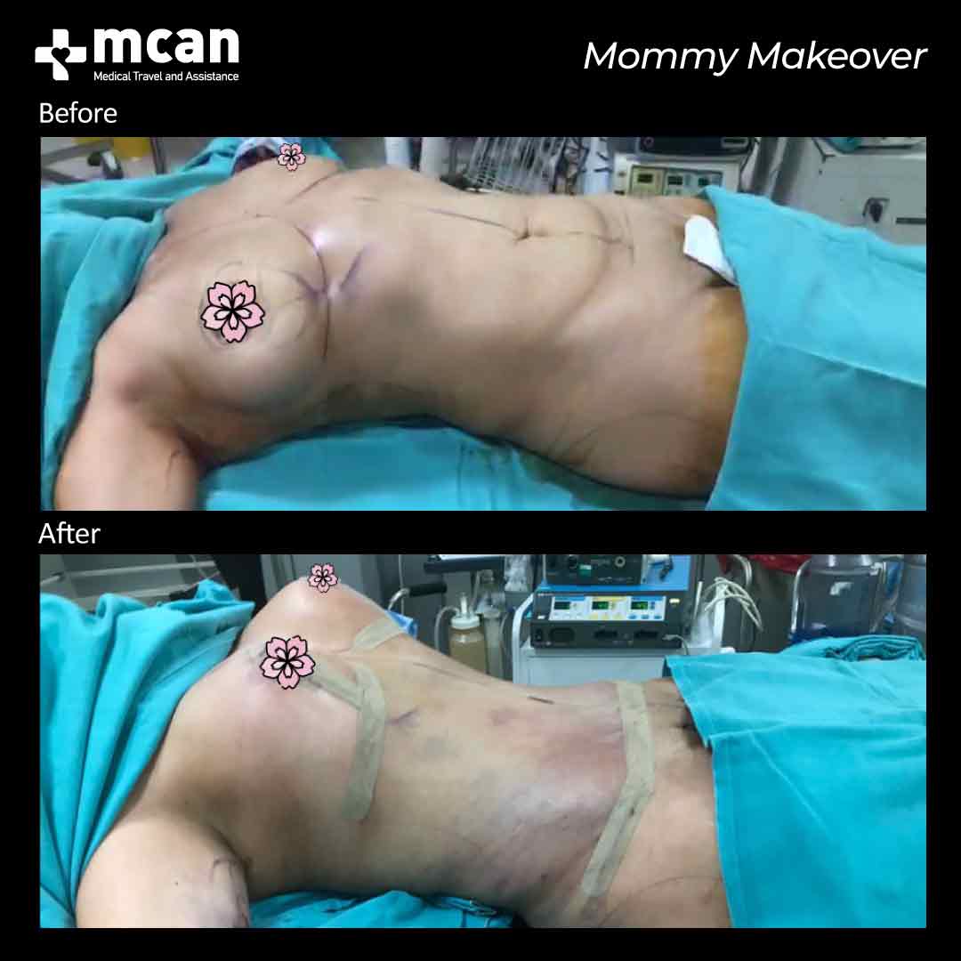 mommy makeover turkey before after 0607202102