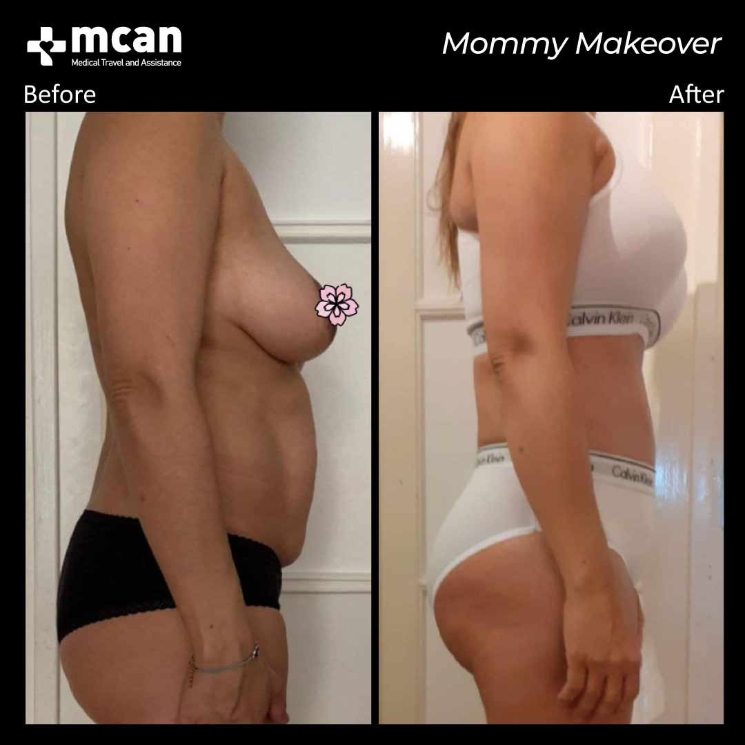 mommy makeover turkey before after 1008202101