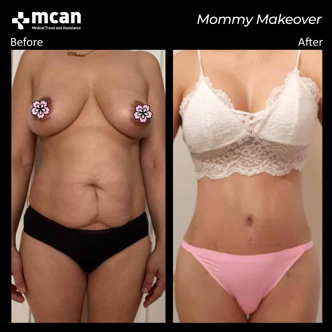 mommy makeover turkey before after 1008202102