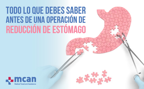 Todo lo que debes saber antes de una operación de reducción de estómago