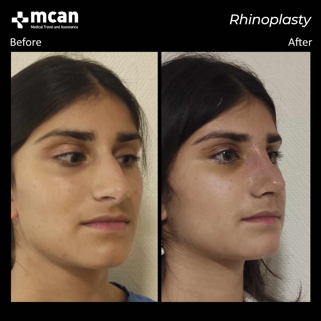 rhinoplasty in turkey before after 1008202101
