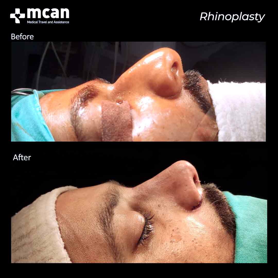 rhinoplasty nose job turkey before after 2108202101