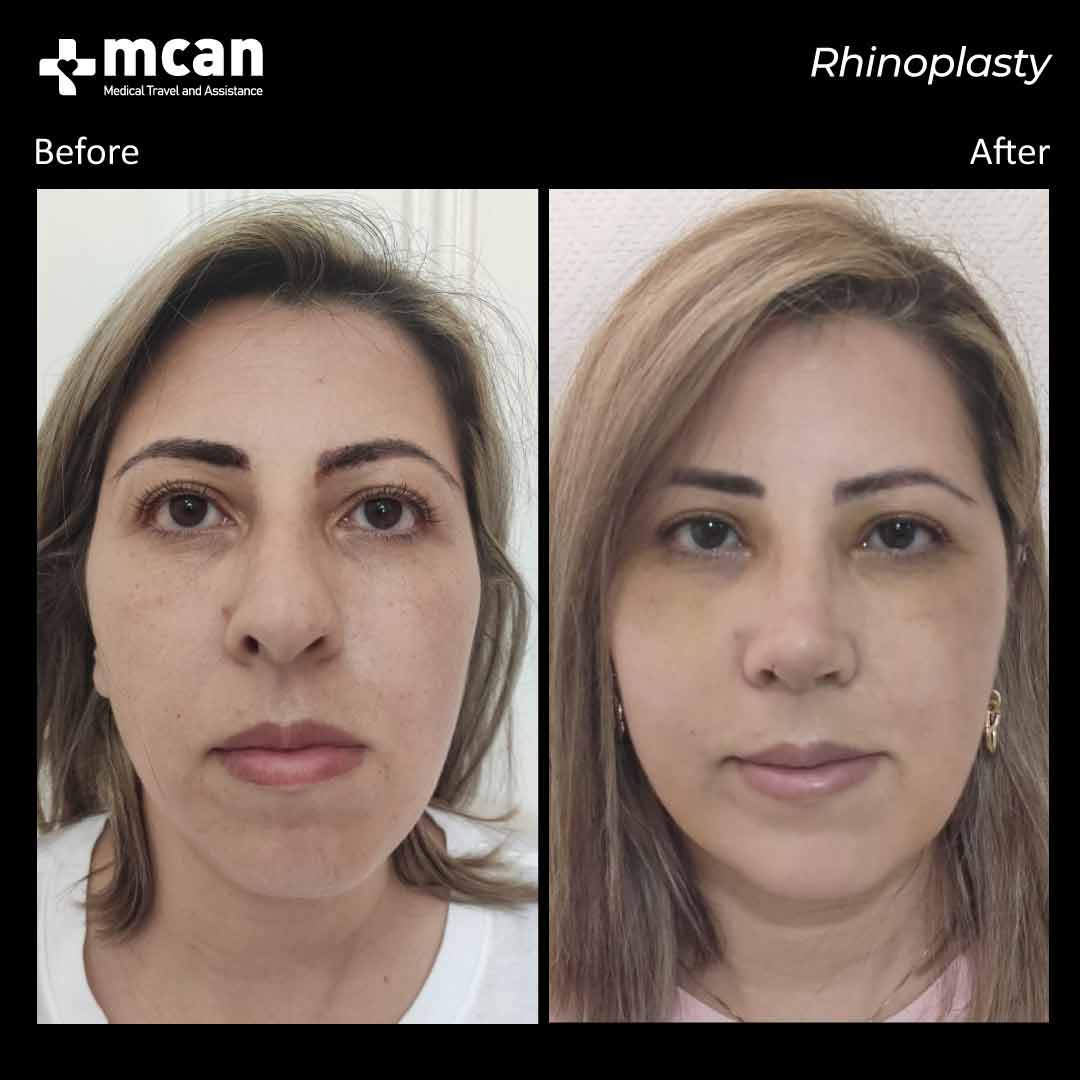 rhinoplasty nose job turkey before after 2108202103