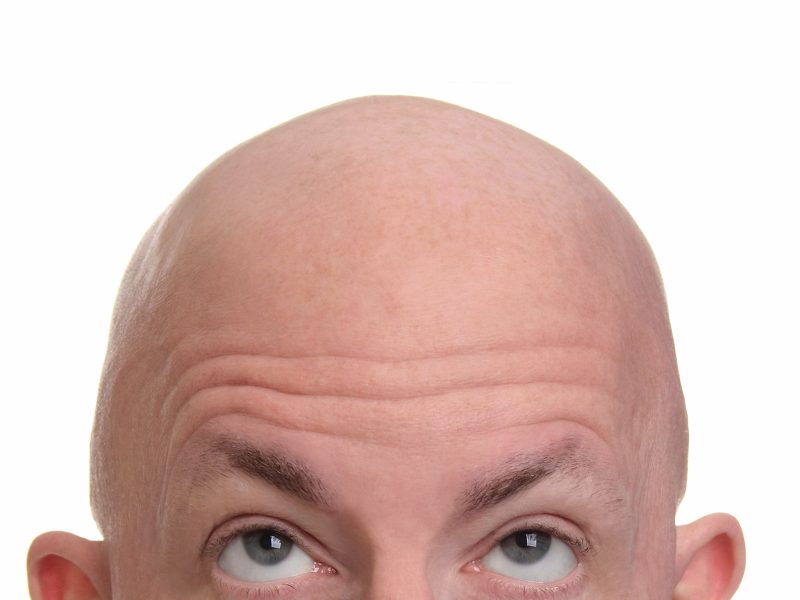 hair transplant pros and cons